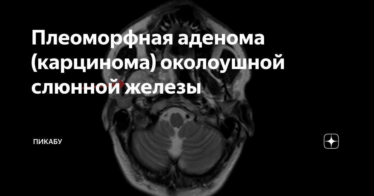 Плеоморфная аденома (карцинома) околоушной слюнной железы | Пикабу | Дзен