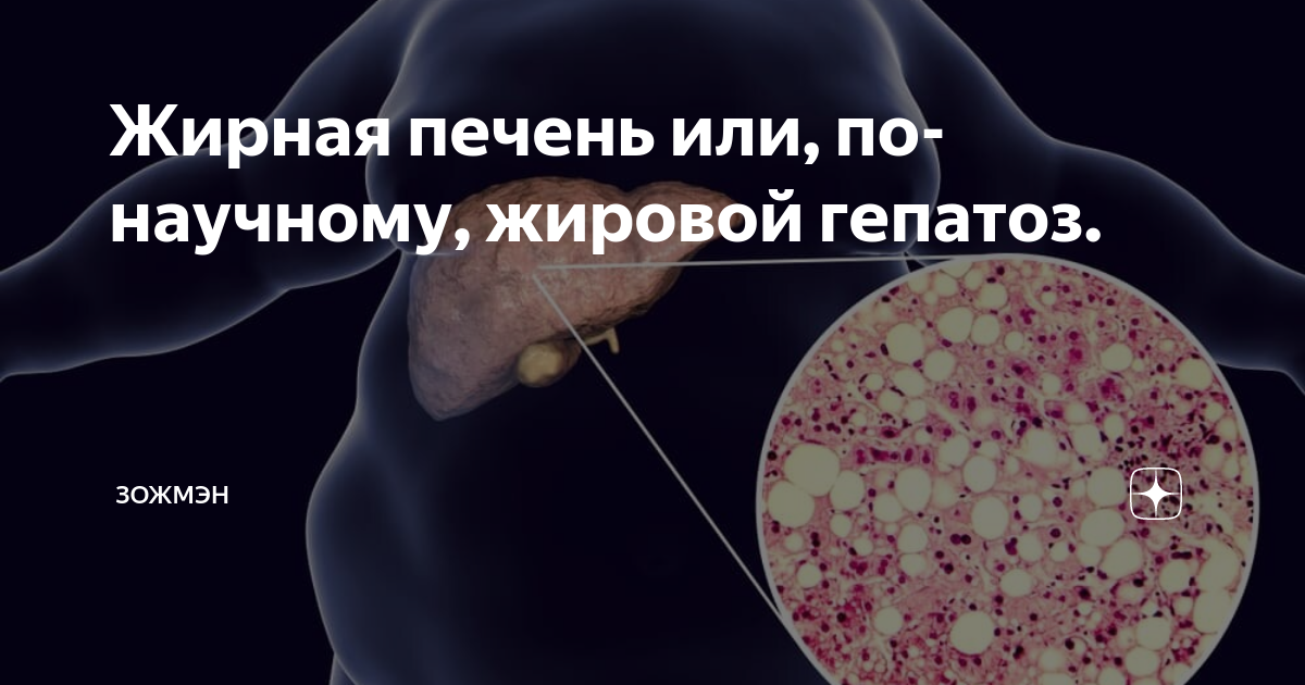 Как помочь печени при жировом гепатозе