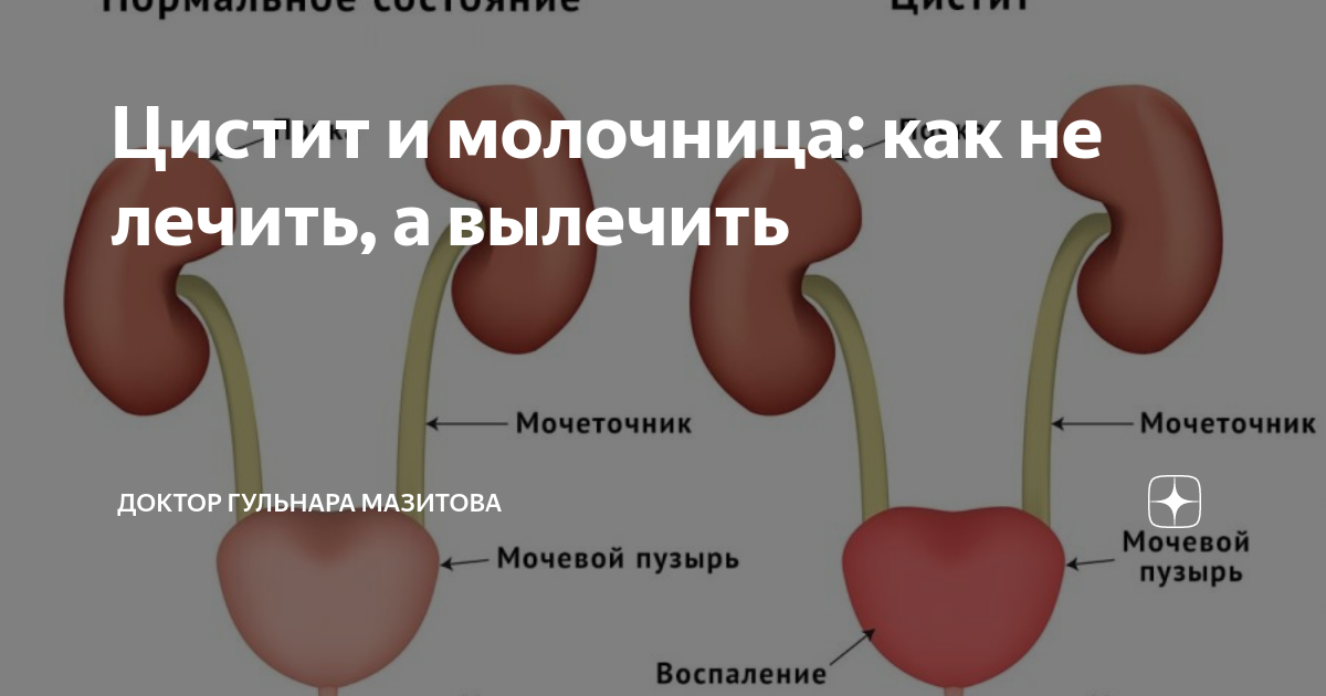 Цистит: симптомы и лечение у женщин и мужчин | Клиника Рассвет