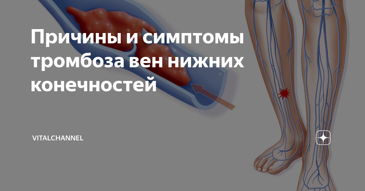 Перианальный венозный тромбоз Перианальный венозный тромбоз