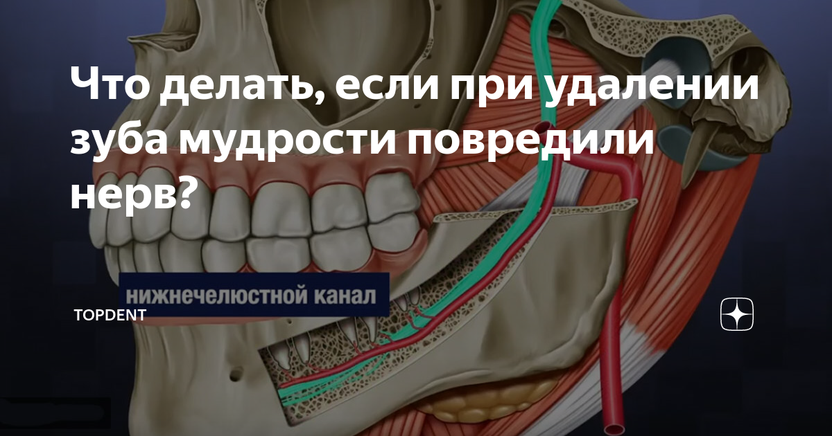 уменьшаются ли щеки при удалении зубов мудрости