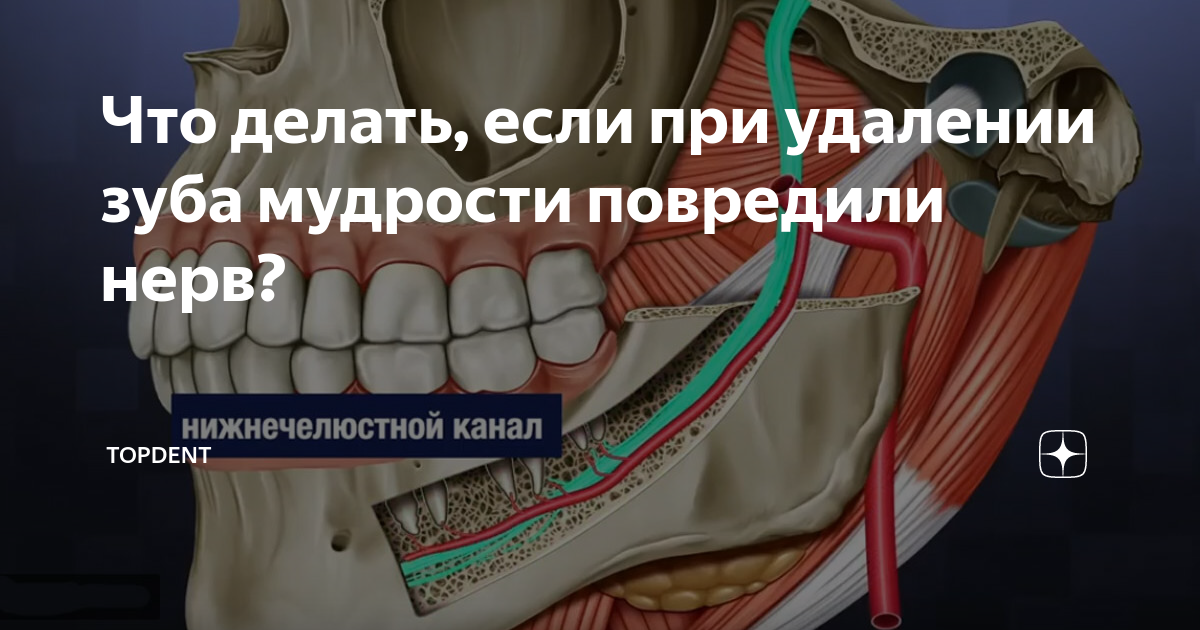 Осложнения при удалении нижнего зуба мудрости | Стоматология «Эстетика»