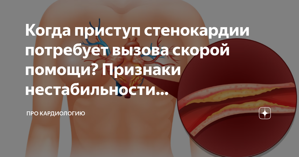 Что такое приступ стенокардии симптомы. Признаки приступа стенокардии. клинические признаки нестабильной гемодинамики. признаки нестабильной бляшки на узи.