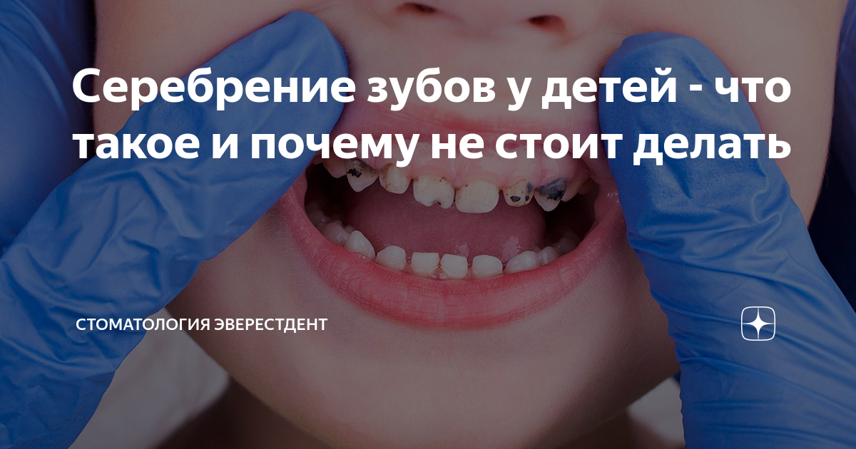 Серебрение зубов - Сеть стоматологических клиник Санкт-Петербурга - Мир стоматологии