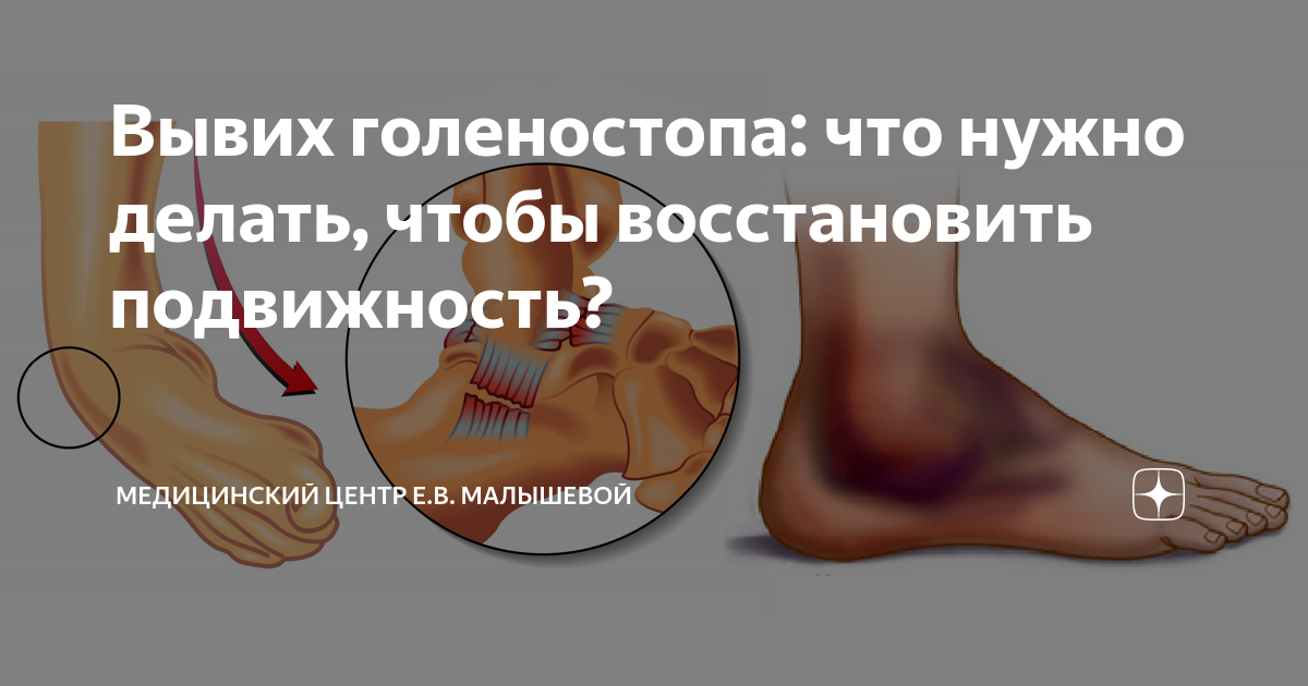 Подвывих голеностопа при отсутствии всяких нагрузок, даже лежа. Растяжение связок голеностопного сустава: восстановление и лечение в Москве Что такое подвывих голеностопа? Что делать при травме голеностопа. Повреждение голеностопного сустава - online presentation
