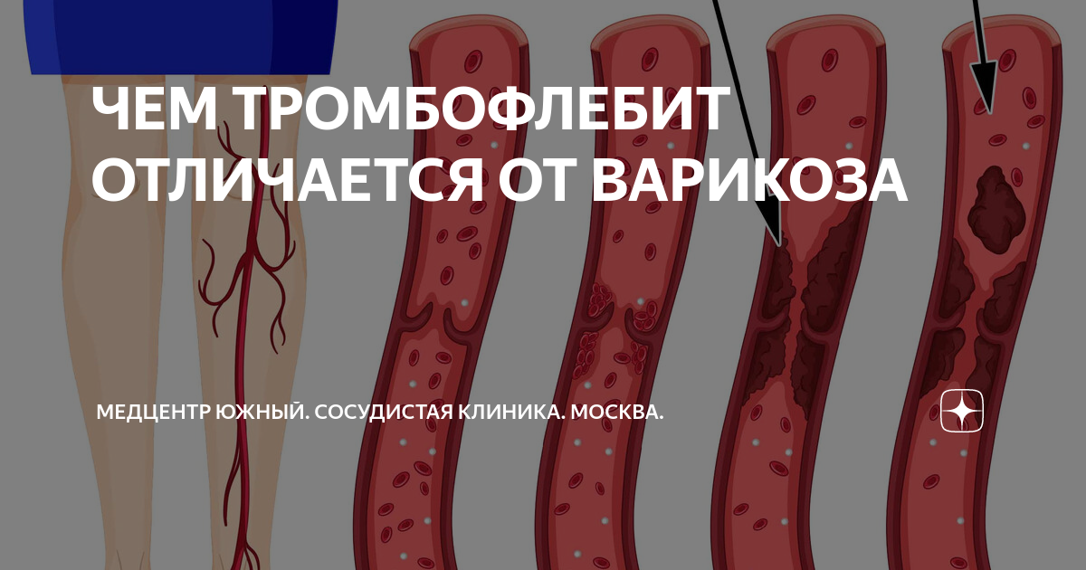 ЧЕМ ТРОМБОФЛЕБИТ ОТЛИЧАЕТСЯ ОТ ВАРИКОЗА | Медицинский центр Южный ...