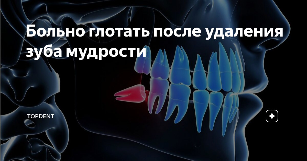 Что делать после удаления зуба мудрости?