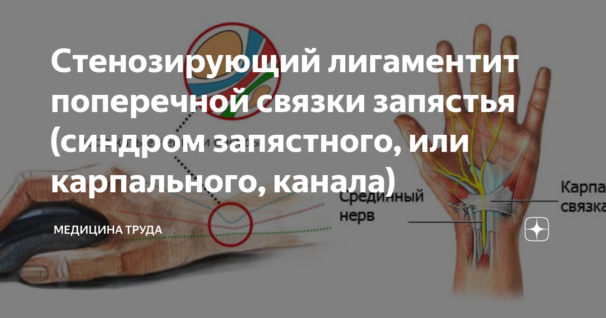 Стенозирующий лигаментит поперечной связки запястья (синдром запястного ...