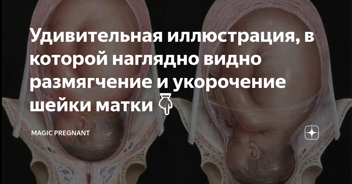 Удивительная иллюстрация, в которой наглядно видно размягчение и ...