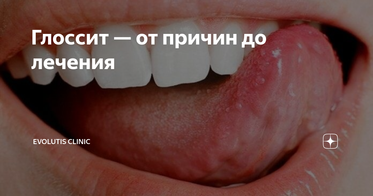 Глоссит — от причин до лечения | Evolutis Clinic | Дзен