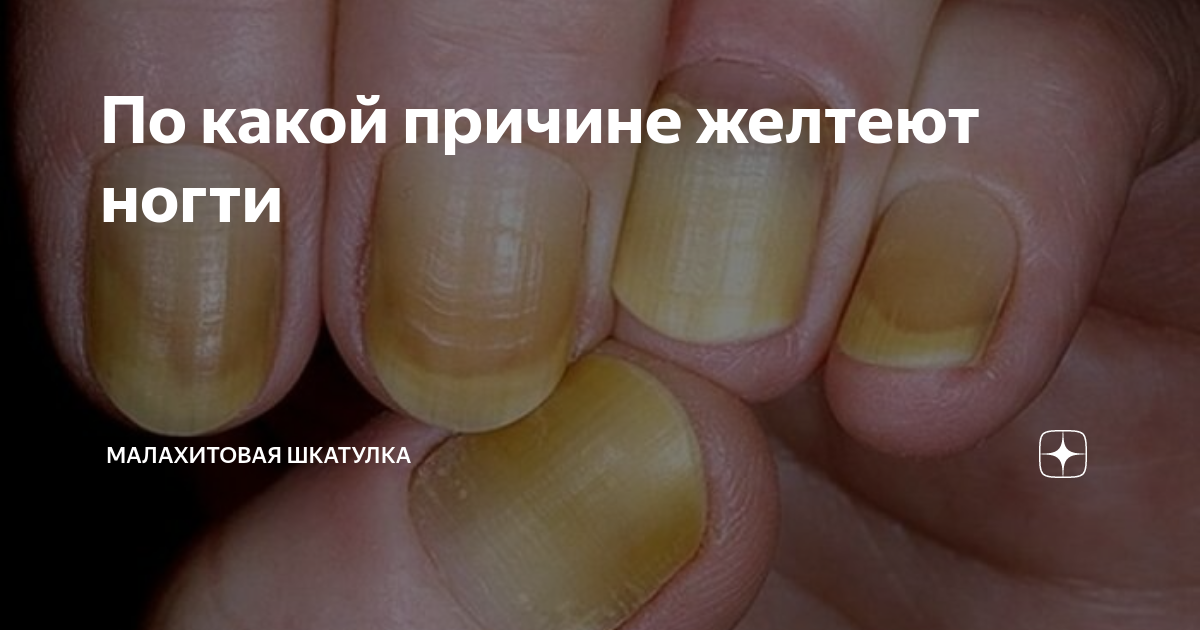 Почему желтеет мужчина. Причины пожелтения ногтей. Желтеют ногти под базой.