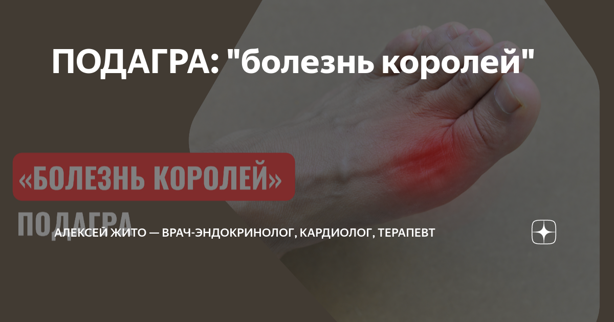 ПОДАГРА: \"болезнь королей\" | Алексей Жито — врач-эндокринолог ...