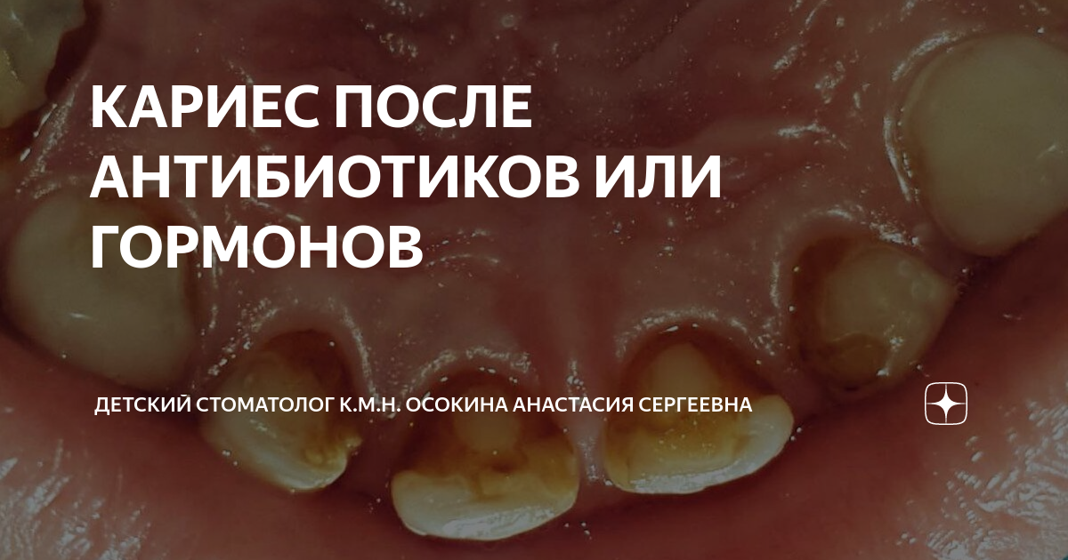 Тетрациклиновые зубы, пигментация эмали