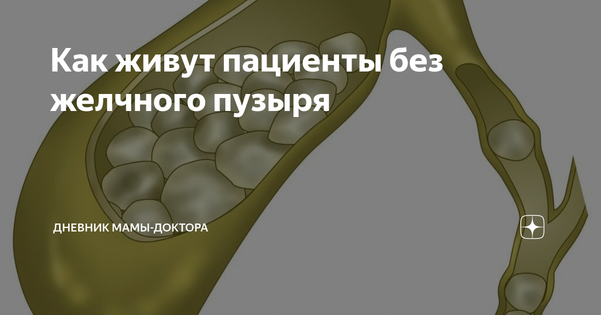как жить без желчного пузыря отзывы