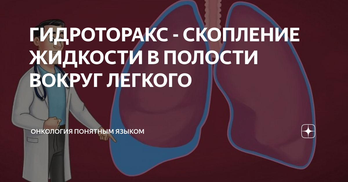 Гидроторакс - причины, симптомы, признаки, классификация, диагностика, лечение