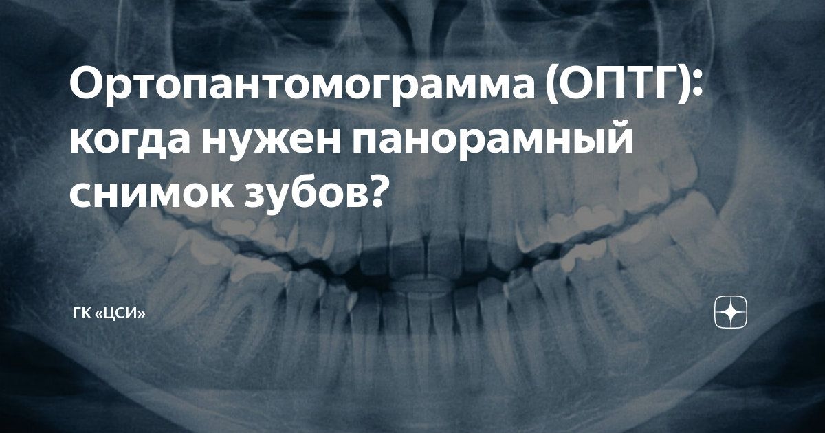 Ортопантомограмма (ОПТГ): когда нужен панорамный снимок зубов? | ГК ...