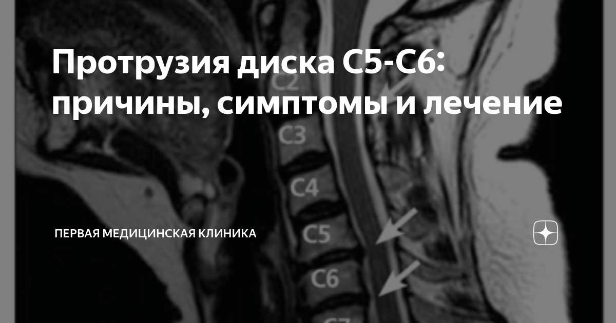 Протрузия диска с6 с7 шейного Протрузия диска с6 с7 шейного