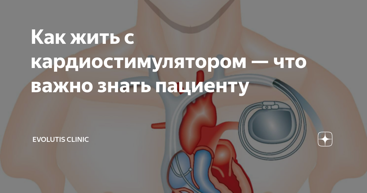 Как жить с кардиостимулятором — что важно знать пациенту | Evolutis ...