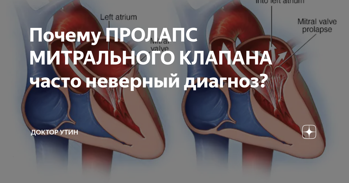 Диагноз пролапс митрального клапана