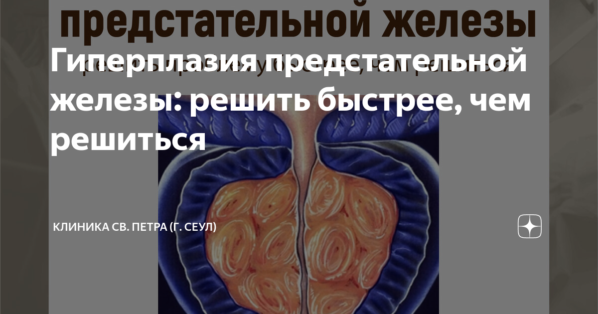 Гиперплазия предстательной железы: решить быстрее, чем решиться ...