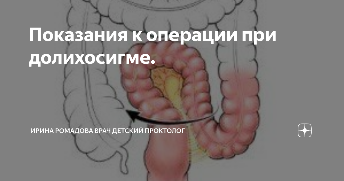 Отсутствие прямой кишки