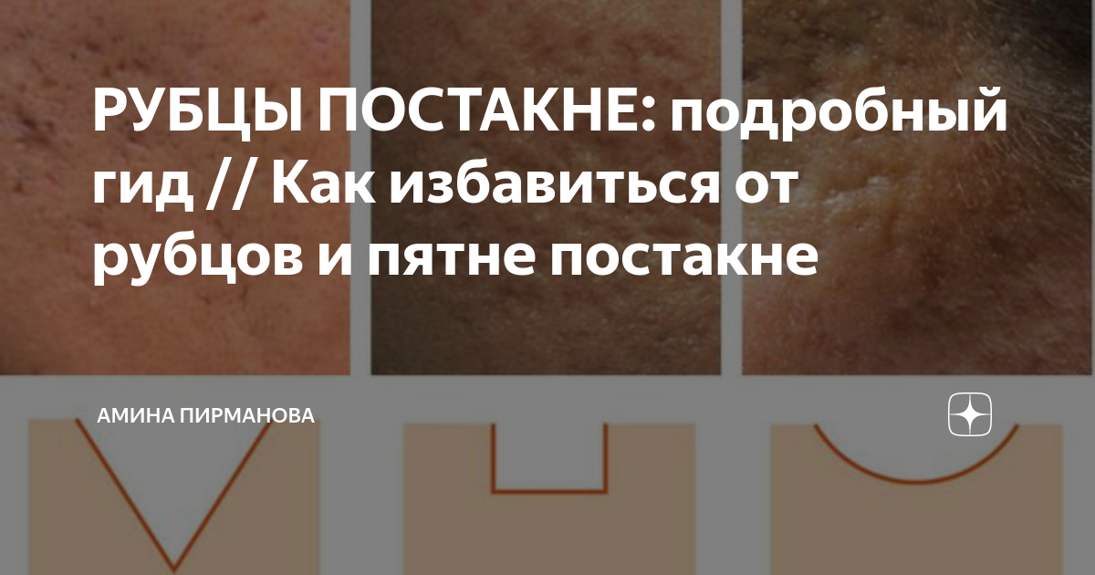 РУБЦЫ ПОСТАКНЕ: подробный гид // Как избавиться от рубцов и пятне ...