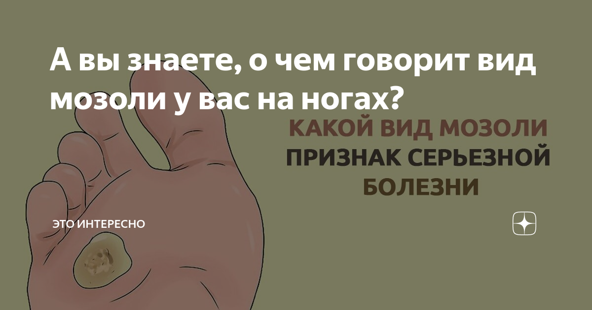 Удаление мозолей жидким азотом (криодеструкция) в СПб. Клиника Мирос