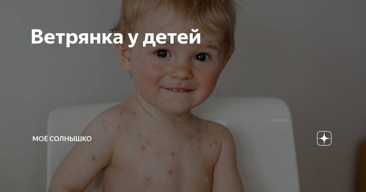 Меры предосторожности при гулянии с ветрянкой:
