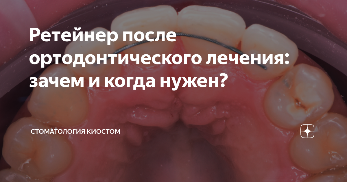 Ретейнер после ортодонтического лечения: зачем и когда нужен ...