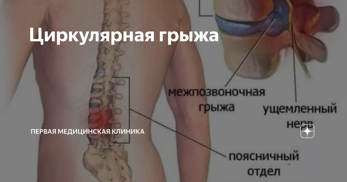 Грыжа отдает в спину Грыжа отдает в спину