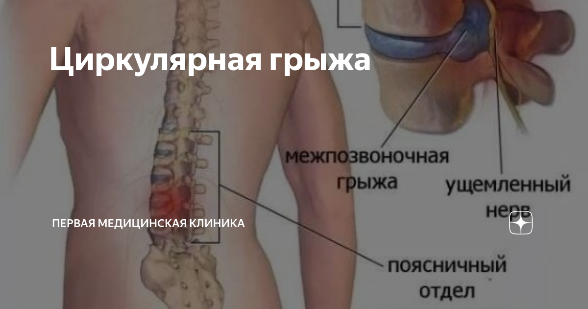 Парамедиальная грыжа позвоночника