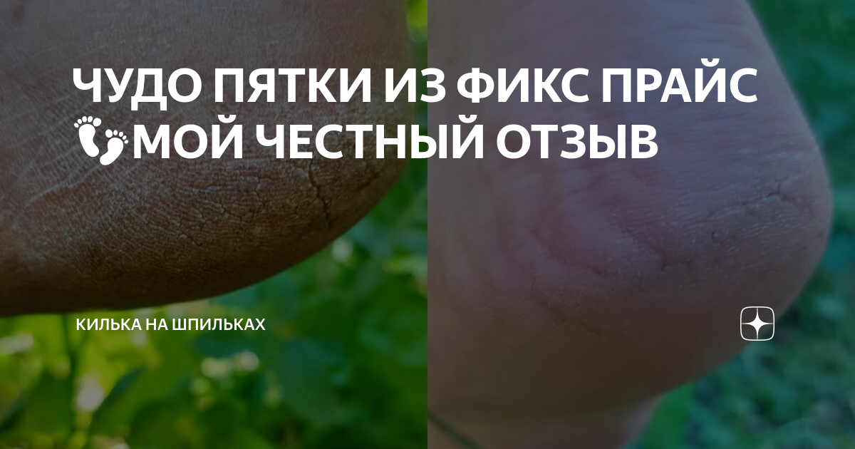 ЧУДО ПЯТКИ ИЗ ФИКС ПРАЙС 👣МОЙ ЧЕСТНЫЙ ОТЗЫВ | Килька на Шпильках | Дзен