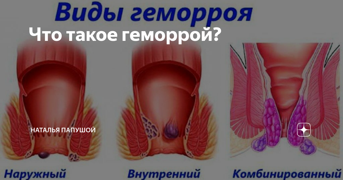 Эффективное лечение геморроя в Севастополе