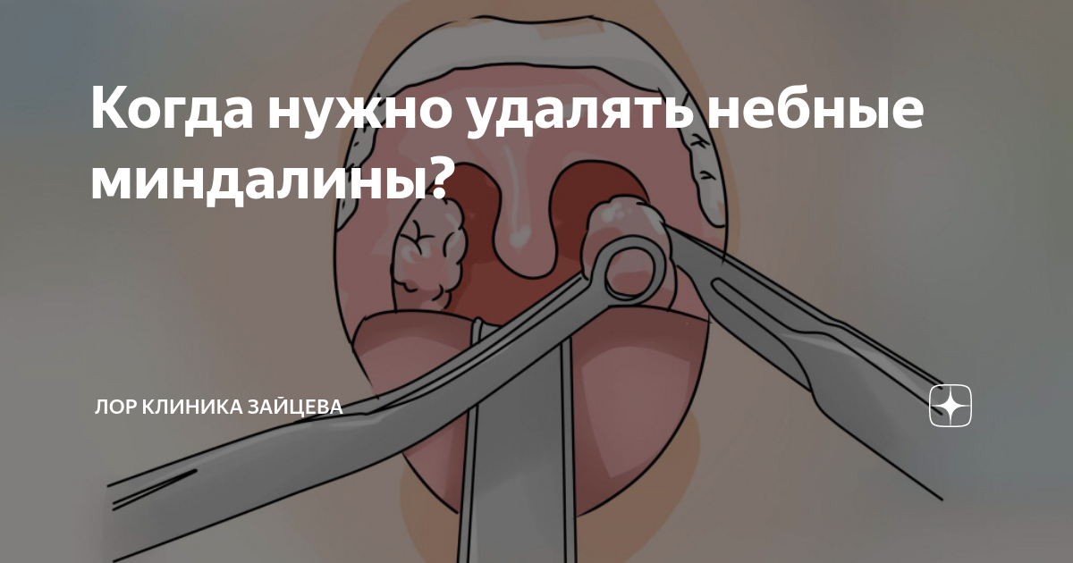 Когда нужно удалять небные миндалины? | ЛОР КЛИНИКА ЗАЙЦЕВА | Дзен