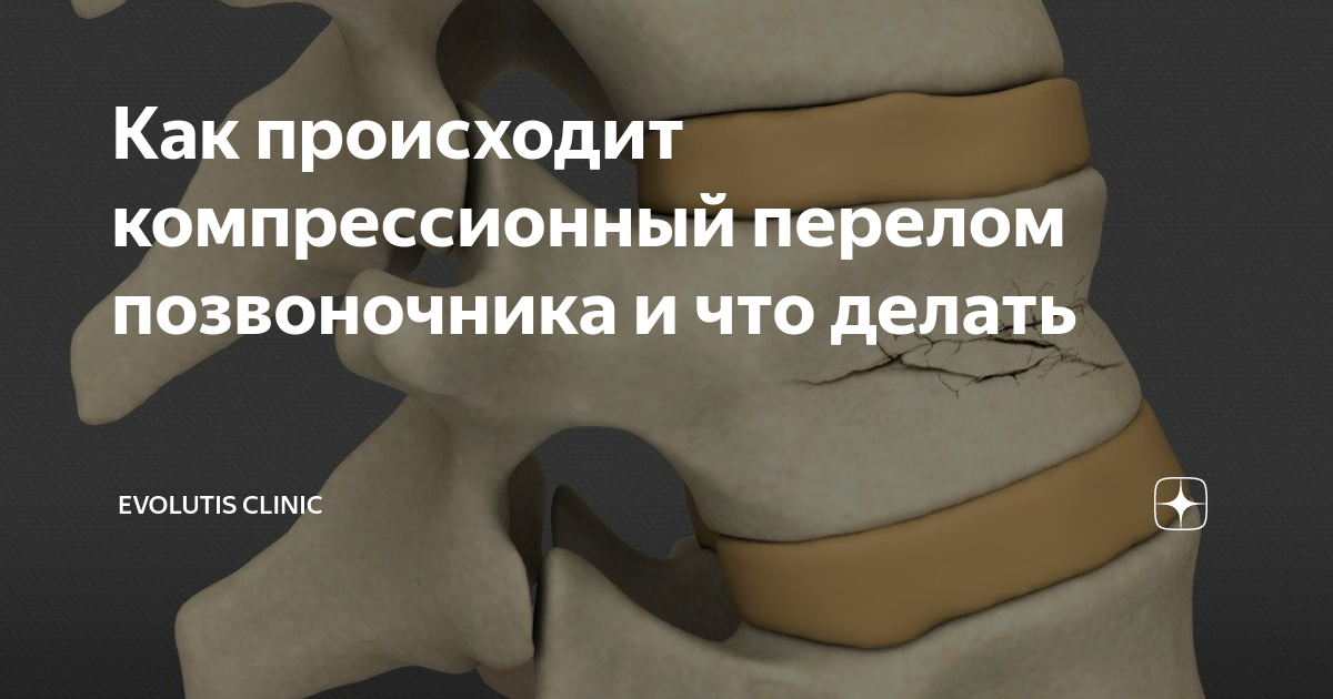 почему нельзя сидеть при компрессионном переломе позвоночника | Дзен