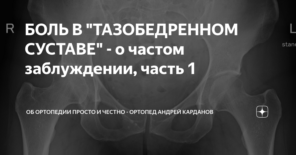 БОЛЬ В "ТАЗОБЕДРЕННОМ СУСТАВЕ" - о частом заблуждении, часть 1 | О ...