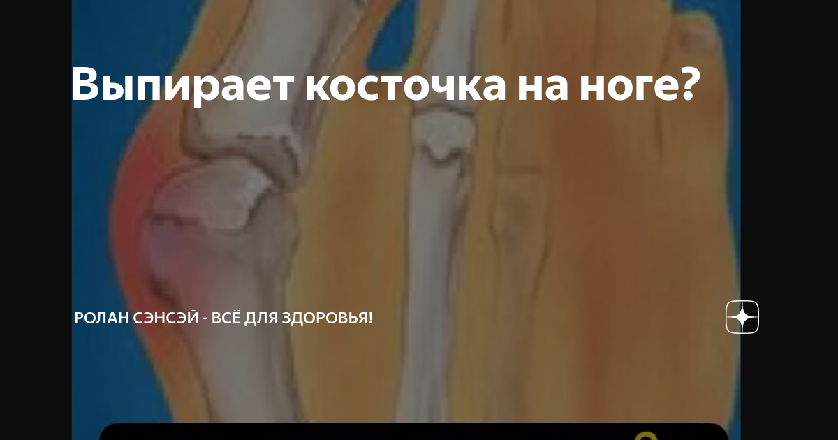 Выпирает косточка на ноге? | Ролан Сэнсэй - Психология самоисцеления ...