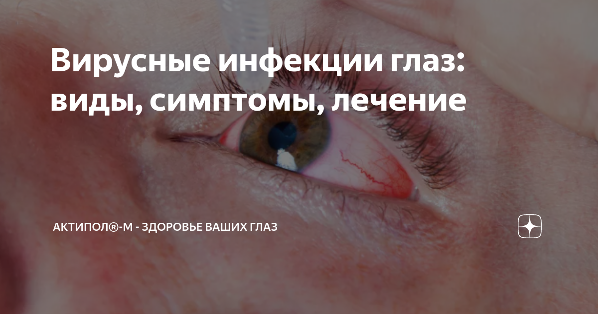 Вирусные инфекции глаз: виды, симптомы, лечение | Актипол®-М - здоровье ...