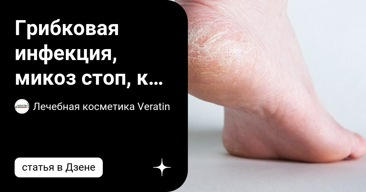 Грибковая инфекция, микоз стоп, как проявляется. | Лечебная косметика ...