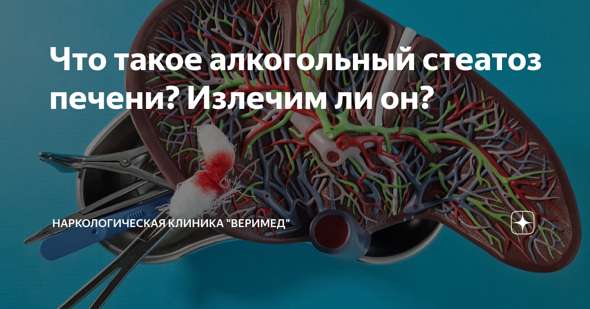 Что такое алкогольный стеатоз печени? Излечим ли он? | Наркологическая ...