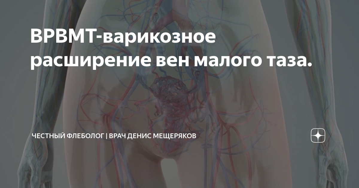 ВРВМТ-варикозное расширение вен малого таза. | Флеболог Москва | врач ...