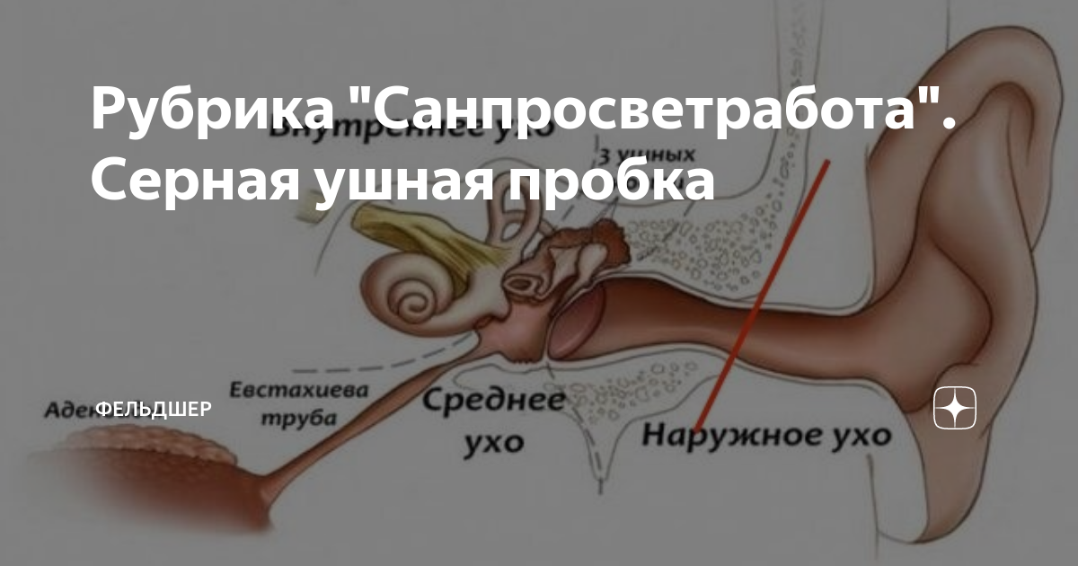 Формула ушной серы. Серная пробка картинки.