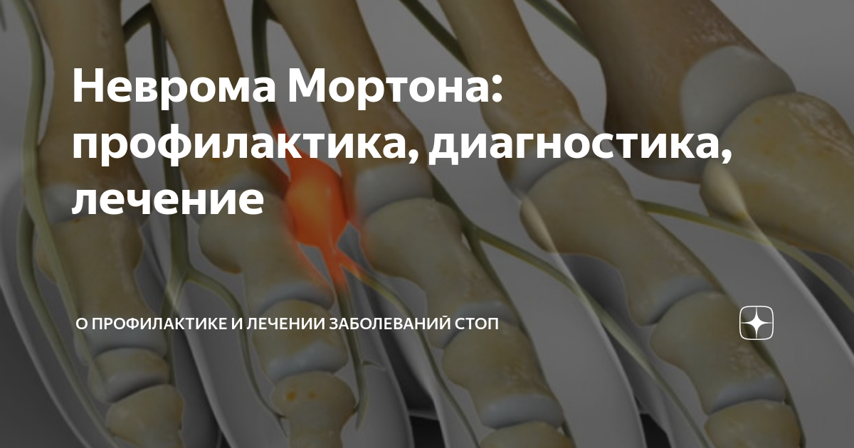 Неврома Мортона: профилактика, диагностика, лечение | Формтотикс ...