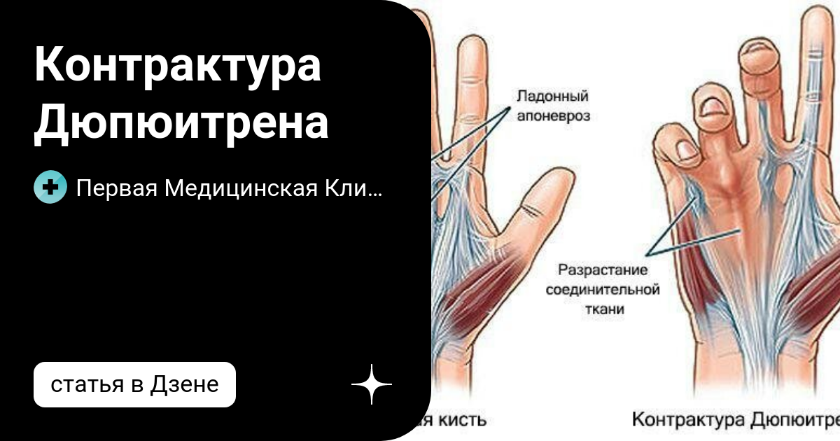 Контрактура дюпетрена лечение народными средствами. Контрактура Дюпюитрена: причины, симптомы, лечение и фото - ГБУЗ МО. ЛЕЧЕНИЕ КОНТРАКТУРЫ ДЮПЮИТРЕНА, КОРРЕКЦИЯ ЛАДОННОГО АПОНЕВРОЗА МАЛОИНВАЗИВНЫМ МЕТОДОМ Контрактура Дюпюитрена: причины, симптомы и лечение — Заболевания.