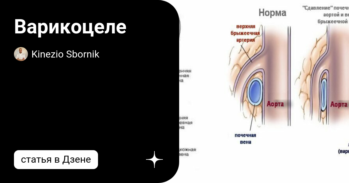 Варикоцеле ростов на дону