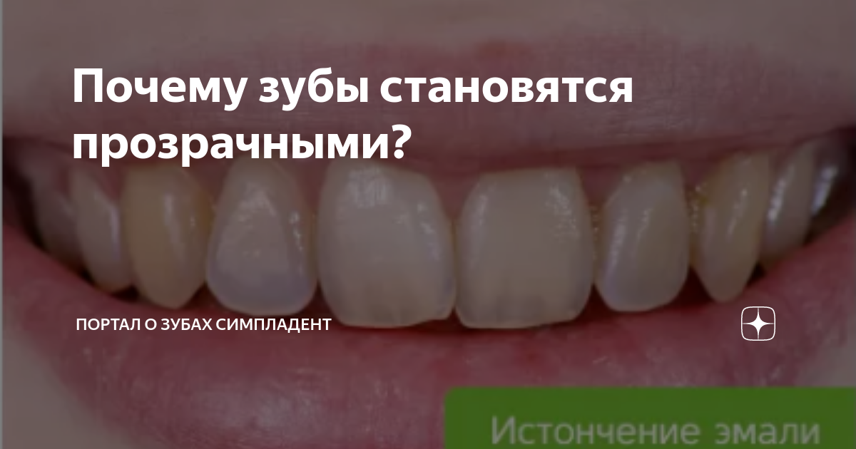 Прозрачная эмаль зубов. Почему зубы прозрачные. Типы прозрачности эмали зубов. Почему зубы прозрачные. Прозрачная эмаль зубов.