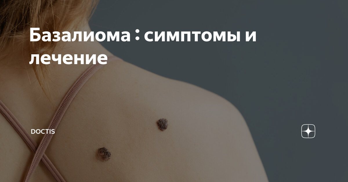 Базалиома : симптомы и лечение | Doctis | Дзен