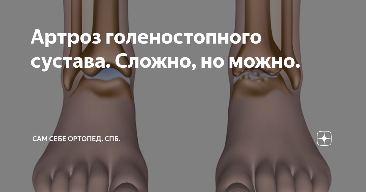 Артроз голеностопного сустава: симптомы, диагностика и лечение | Справочник КЛРЦ