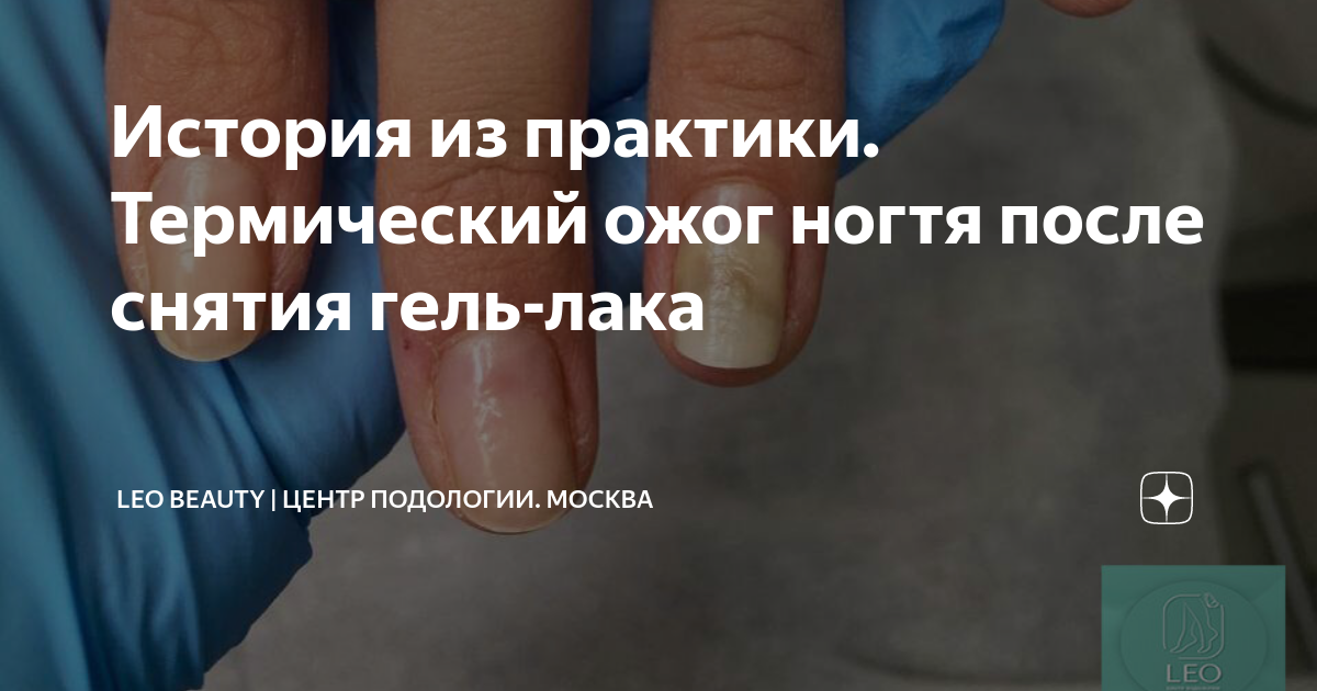 История из практики. Термический ожог ногтя после снятия гель-лака ...
