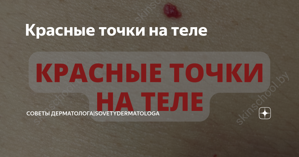 Красные точки на теле | Советы дерматолога|Sovetydermatologa | Дзен